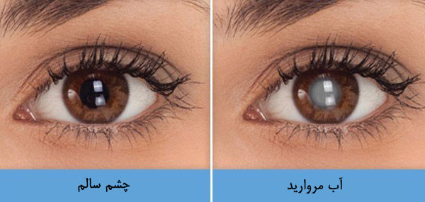 normal and cataracts eye dralimardani com